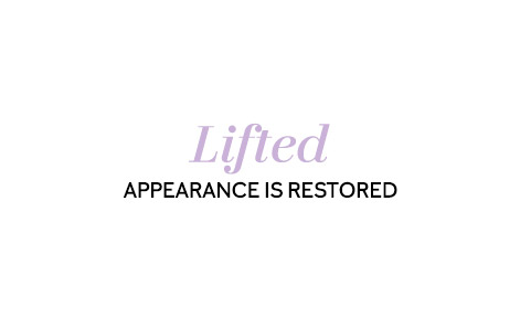 Lifted appearance is restored.