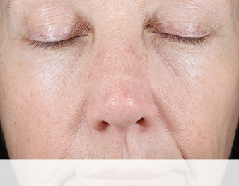 Mary Kay Clinical Solutions Retinol 0.5 Set after image of mid-face