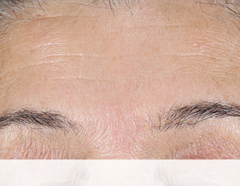 Mary Kay Clinical Solutions Retinol 0.5 Set before image of forehead