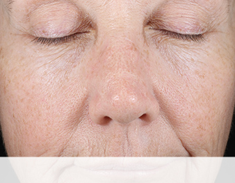 Mary Kay Clinical Solutions Retinol 0.5 Set before image of mid-face